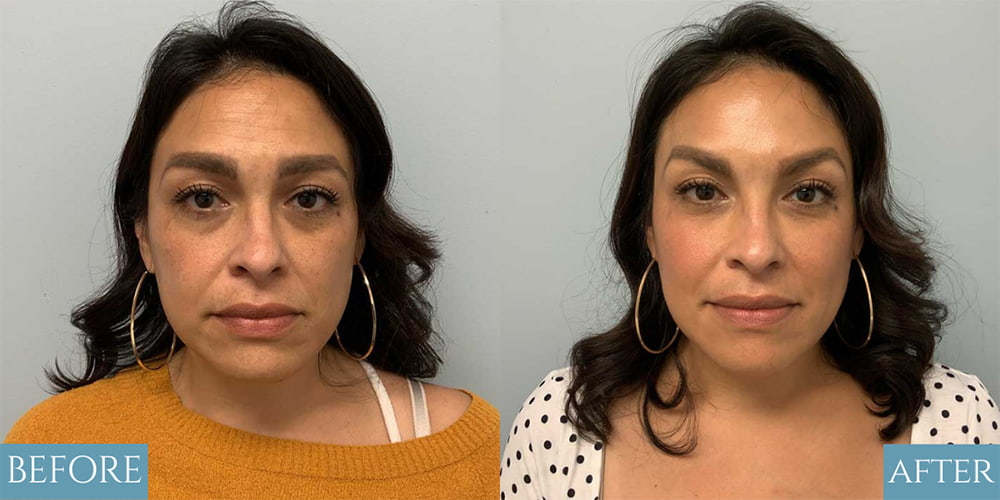 Botox® Before and After